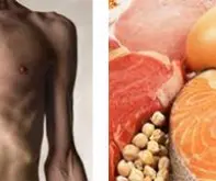 نشانه های کمبود پروتئین در بدن